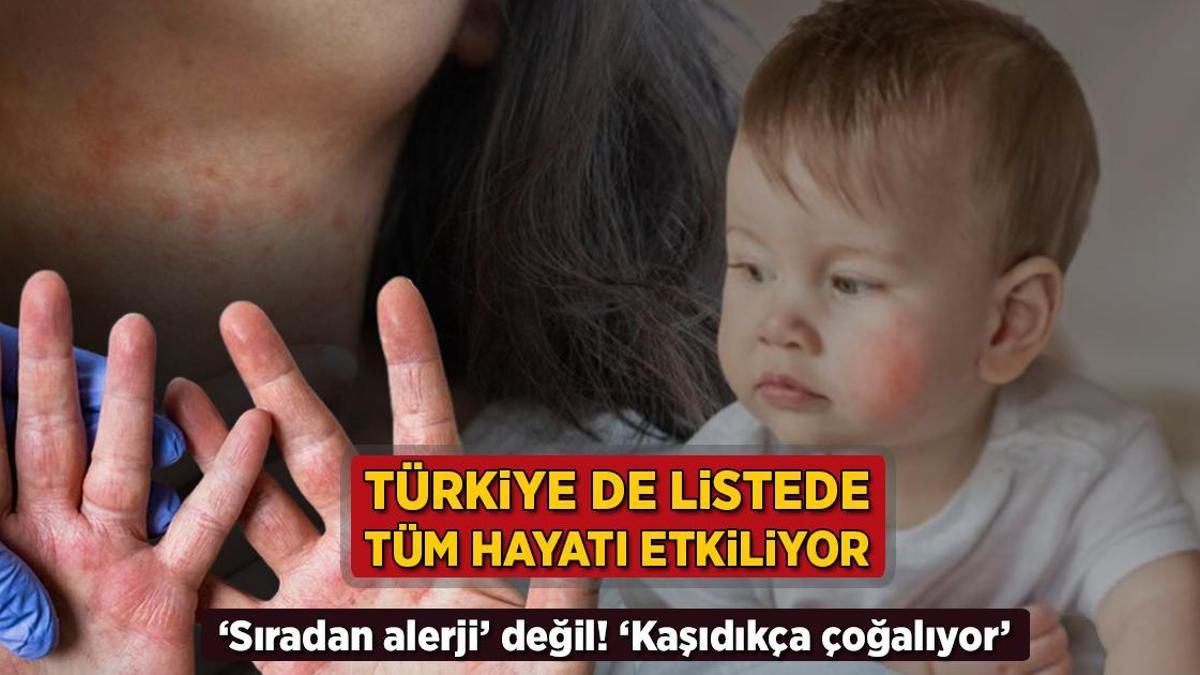 turkiye de listede tum hayati kotu etkiliyor siradan alerji degil kasidikca cogalir GqWgt1ga.jpg